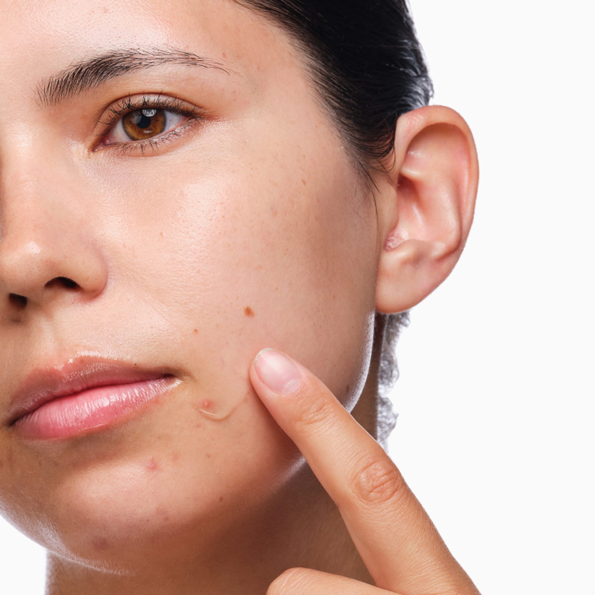 the-acne-set-k7 rdn-the-acne-set-application.png