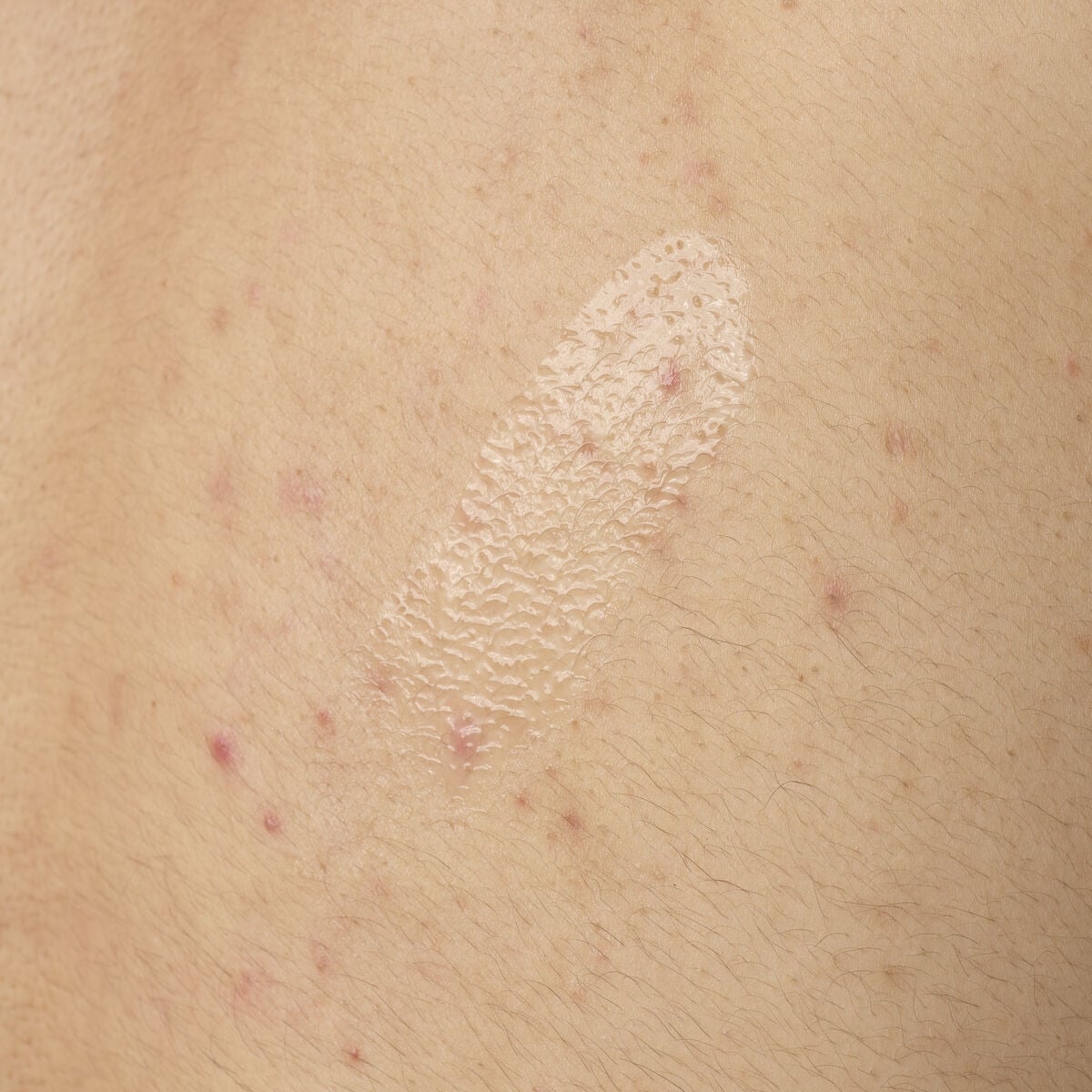 salicylic-acid-0-5-body-serum-g8 ORD-salicylic-acid-05-body-240ml-application.jpg