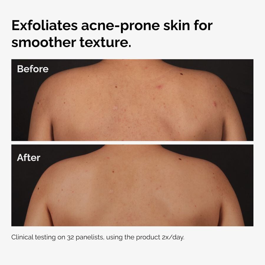 the-body-care-collection-p8 ord-salicylic-acid-body-serum-before-after-graphic-NA.jpg